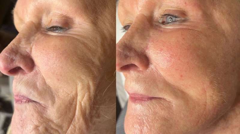 RF Microneedling for the Face